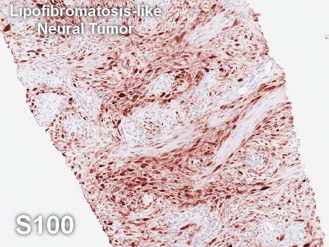Lipofibromatosis-like Neural Tumor2_S100_cropped.jpg